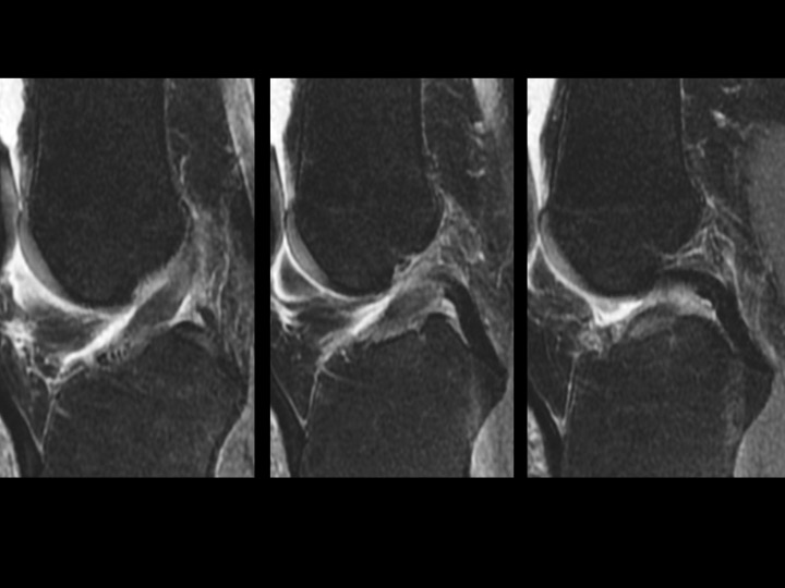 Figure 4 for case anterior cruciate ligament ( RID2781 )